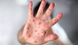 Virus Mpox Belum Terdeteksi di Riau, Masyarakat Diminta Tetap Waspada