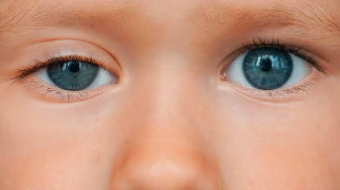Pentingnya Deteksi Dini Ambliopia untuk Jamin Penglihatan Anak