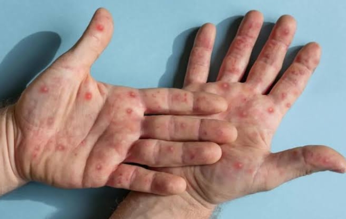 Ada 88 Kasus MPOX di Indonesia, Kemenkes Imbau Masyarakat untuk Tetap Waspada